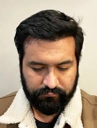 Tijuana Hair Transplant Reviews and Testimonials