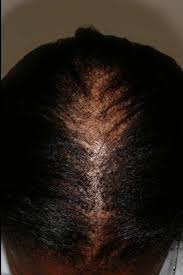 But excessive pulling at the scalp without proper technique and care can lead to breakage, or even worse, hair loss. Ccca Hair Loss Black Women Hair Loss Hair Loss Women Treat Thinning Hair