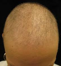 The efficacy of the therapy was assessed by questioning patients (reduce of the hair loss intensity) and trichoscopy before therapy and after two months. Drug Eruptions Practice Essentials Background Pathophysiology