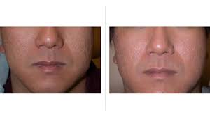 The process uses concentrated light to target and damage individual hair follicles. Laser Treatment For Scars Cost Effectiveness Face And More
