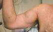 Distal biceps tendon rupture Sydney