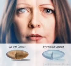 Cataract Surgery Recovery Time And Associated Risks Cataract Surgery Recovery Cataract Cataract Surgery