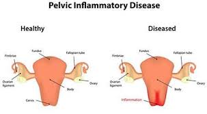 What are the symptoms of pelvic inflammatory disease? Pelvic Inflammatory Disease Nyc Pid Treatment Specialist Dr Mariz