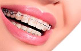 Each consultation after that usually ranges from $60 usd to $120 usd with a total of anywhere from 8 consultations to 36 consultations depending on the extent of the treatment. Braces Cost In Mexico Orthodontic Treatment Costs For Mexico 2019
