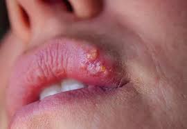 Image result for Oral herpes roof of mouth