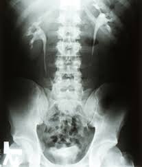 Image result for Intravenous Pyelogram