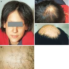 It has a rare but reported side effect of hair loss. Examining Hair Loss In Men Springerlink