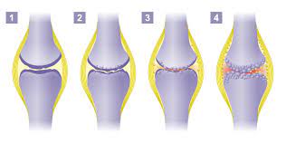 Die am häufigsten betroffenen gelenke sind knie, hüfte und finger, es knirscht bei bestimmten bewegungen. Arthrose Gelenkerhaltende Therapie Gelenk Klinik De