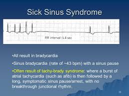 Image Result For Sick Sinus Syndrome Ecg