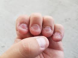 dark lines on fingernails causes