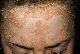 Slideshow Types Of Psoriasis Plaque Psoriasis Treatment Psoriasis On Face Pustular Psoriasis