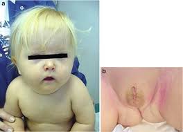 The syndrome is characterized by proportionate short stature, craniofacial dysostoses. Hallermann Streiff Syndrome Springerlink