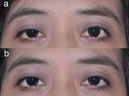 Comparison of clinical outcomes of conjunctivo-mullerectomy for varying  degrees of ptosis