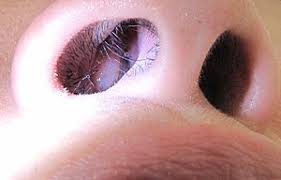 An endoscope—a long tube that has a light and video camera at the end—will be inserted in one of your nostrils and several tools will be used to remove your nasal polyps. Nasal Polyp Wikipedia