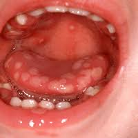 When you get a virus, you may not always get sick from it. Oral Ulceration Causes And Management Learning Article Pharmaceutical Journal