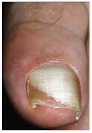 Image result for onychomycosis