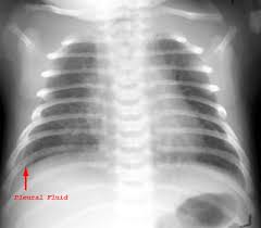Mediastinum in neonate has much variability and mainly consist of heart and thymus…. Pediatric Radiology