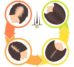 However, those with a genetic predisposition. What Are The Causes Of Hair Loss After Surgery Elithairtransplant