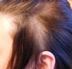 Hair loss is a symptom. Diffuse Hair Loss Or Generalized Hair Loss Is A Condition Wherein Hair Loss Or Hair Thinning Occurs On The Hair Loss Cure Hair Loss Remedies Diffuse Hair Loss
