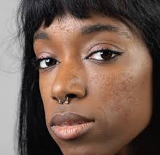 Why Preoperative Consultations Matter: A Case for Better Planning in  Dermatologic Surgery