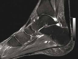 Calcification and tendon degeneration near the rotator cuff insertion. Tendinopathie Et Rupture Du Tendon D Achille Evaluation Radiologique La Medecine Du Sport