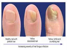 Hongos En Las Uñas De Las Manos Como Eliminarlos Tratamientos Para Los Hongos En Las Unas Sin Medicinas Sentirse Bien Es Facilisimo Com Hongos En Las Unas Remedio Para Hongos Remedios Hongos Unas