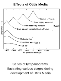 Image result for Tympanometry
