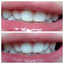 Most often, that means a filling. Smile Gallery Cavities Front Tooth Cavity Tooth Cavity