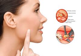 Una vez que ha sido anestesiada el área, se. Bolas De Bichat Bichectomia Bichectomia Estiliza Tu Rostro