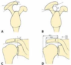 These were depicted by bigliani as type 1 acromion, type ii or sort iii. Overview Of Parameters Of Acromial Morphology A Acromial Slope D Download Scientific Diagram