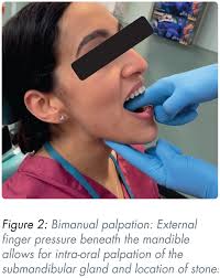 Image result for Submandibular Exam
