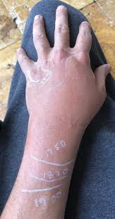 Image result for Fly Bite