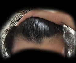 Learn the most common signs of low. 18 Male Early Signs Of Balding What Can I Do Hairlosstalk Forums