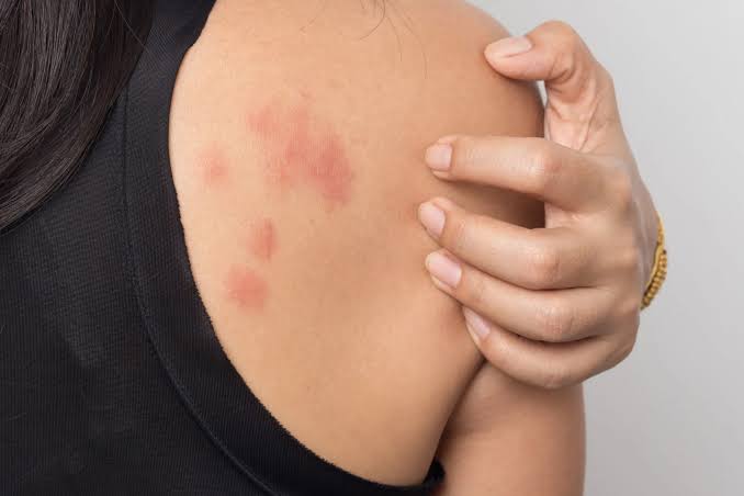 Hives - Urticaria | Dermatologist Philadelphia | Dermatology Practice Main  Line PA - Ringpfeil Advanced Dermatology