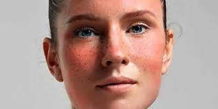 With rosacea, we want to avoid or reduce foods that 'warm' the body up… like chilli, curries or cinnamon. Rosacea Treatment 6 Natural Remedies To Use Dr Axe