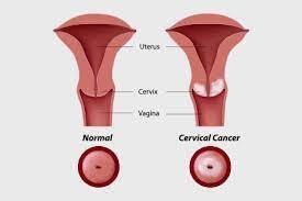 If they do, some symptoms. Cervical Cancer Symptoms Diagnosis And Treatment