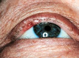 Broken skin on the eyelid that does not heal. Management Of Eyelid Malignancies