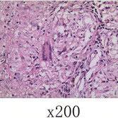 When sarcoidosis affects the lungs, symptoms can mimic idiopathic pulmonary fibrosis including shortness of breath and a dry cough. Pdf Sarcoidosis Misdiagnosed As Malignant Tumors A Case Report