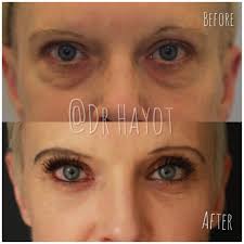 The top countries of supplier is china, from which the percentage. Dark Circles Treatment With Fat Transfer In London Epilium Skin