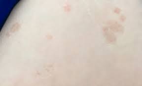 Plotzlich Braune Flecken Auf Der Haut Gesundheit Medizin Korper