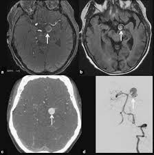 A brain aneurysm is a weakness in a blood vessel in the brain. Non Invasive Diagnosis Of Intracranial Aneurysms Sciencedirect