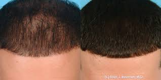 Hair loss is one of the natural fashion disasters. Prp Platelet Rich Plasma Therapy Acell Biod Ecms Bauman Medical