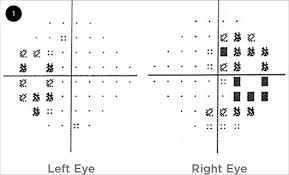 Image result for Visual Field Deficit