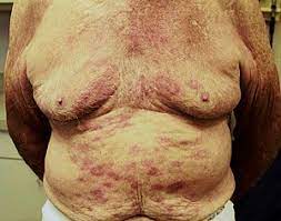 Leprosy Wikipedia