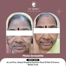 Image result for Photodermatitis