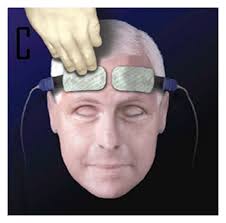Continuous Measurement of Cerebral Oxygenation with Near‐Infrared  Spectroscopy after Spontaneous Subarachnoid Hemorrhage