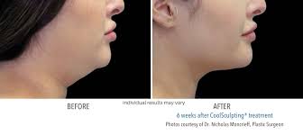 Coolsculpting before and after images illustrate what is possible with this revolutionary body contouring treatment. Coolsculpting Before After Images Real Patient Results