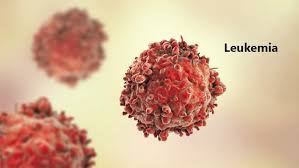 Leukemia: Causes, Symptoms, Risk factors, Diagnosis, and Treatments -  Medlife Blog: Health and Wellness Tips