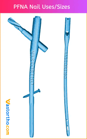 PFNA Nail Uses, Sizes & Surgical Techniques • Vast Ortho