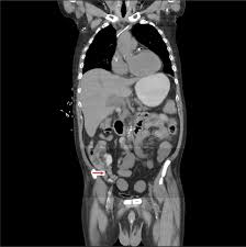 Image result for Neutropenic Colitis